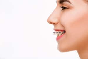 Orthodontic Treatment Fix Overbite