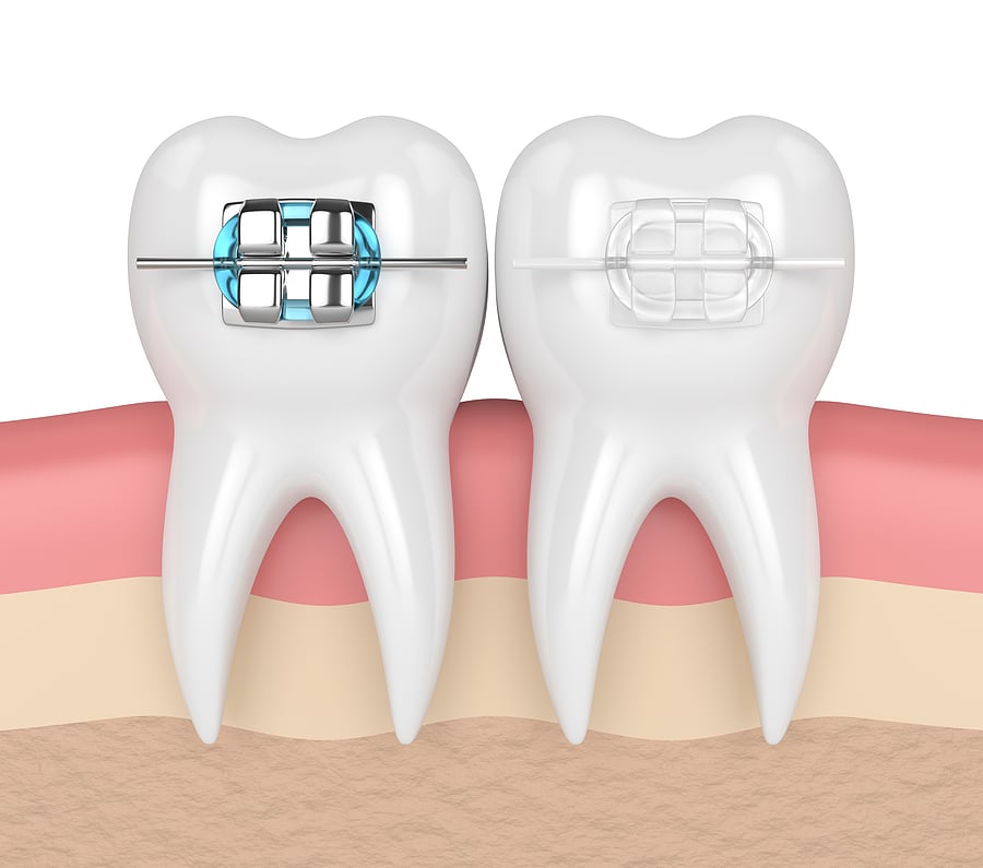 Understanding the Different Types and Benefits of Braces