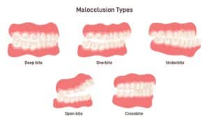 different types and benefits of braces