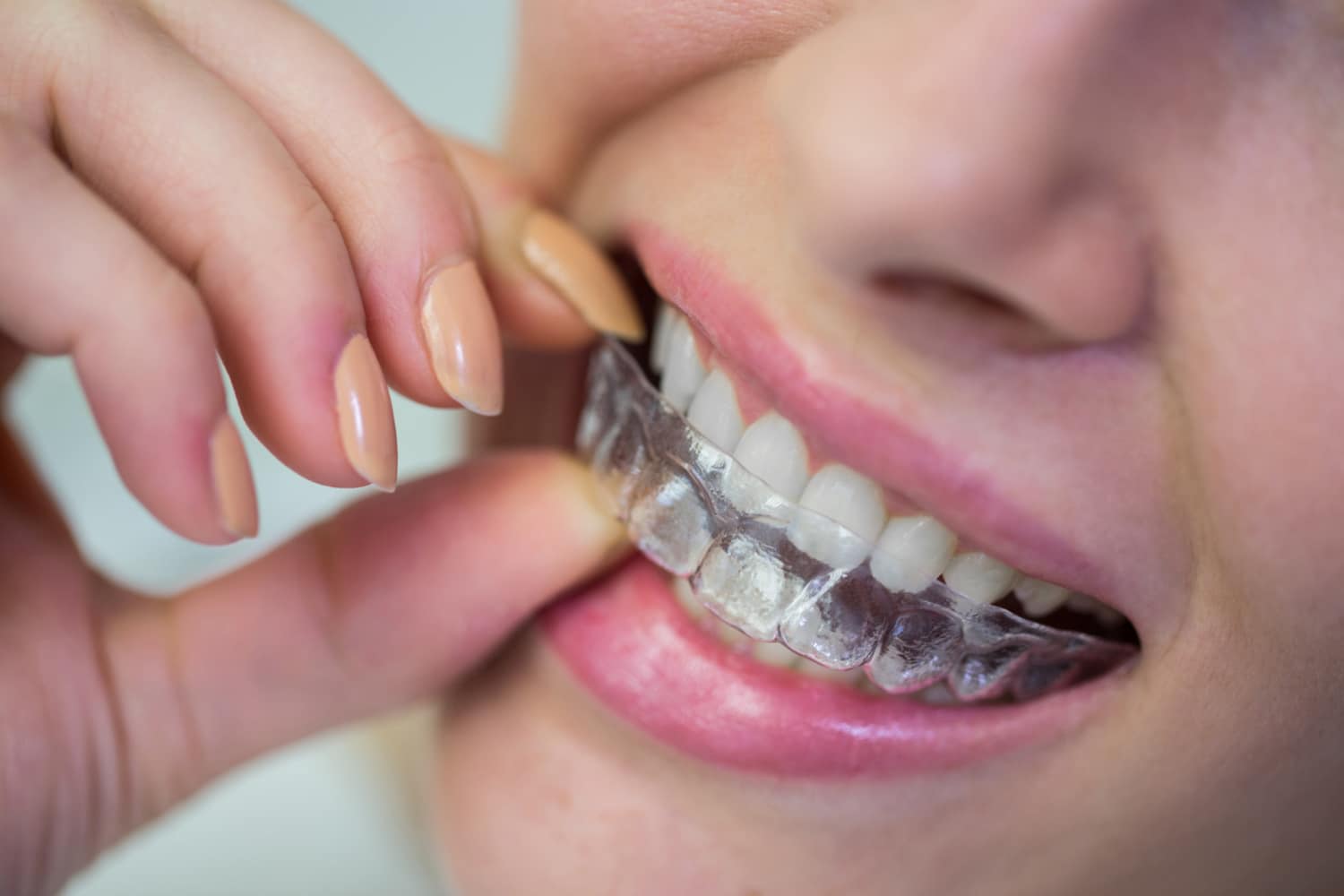 Invisalign Treatment Length Explained: Key Factors & Tips