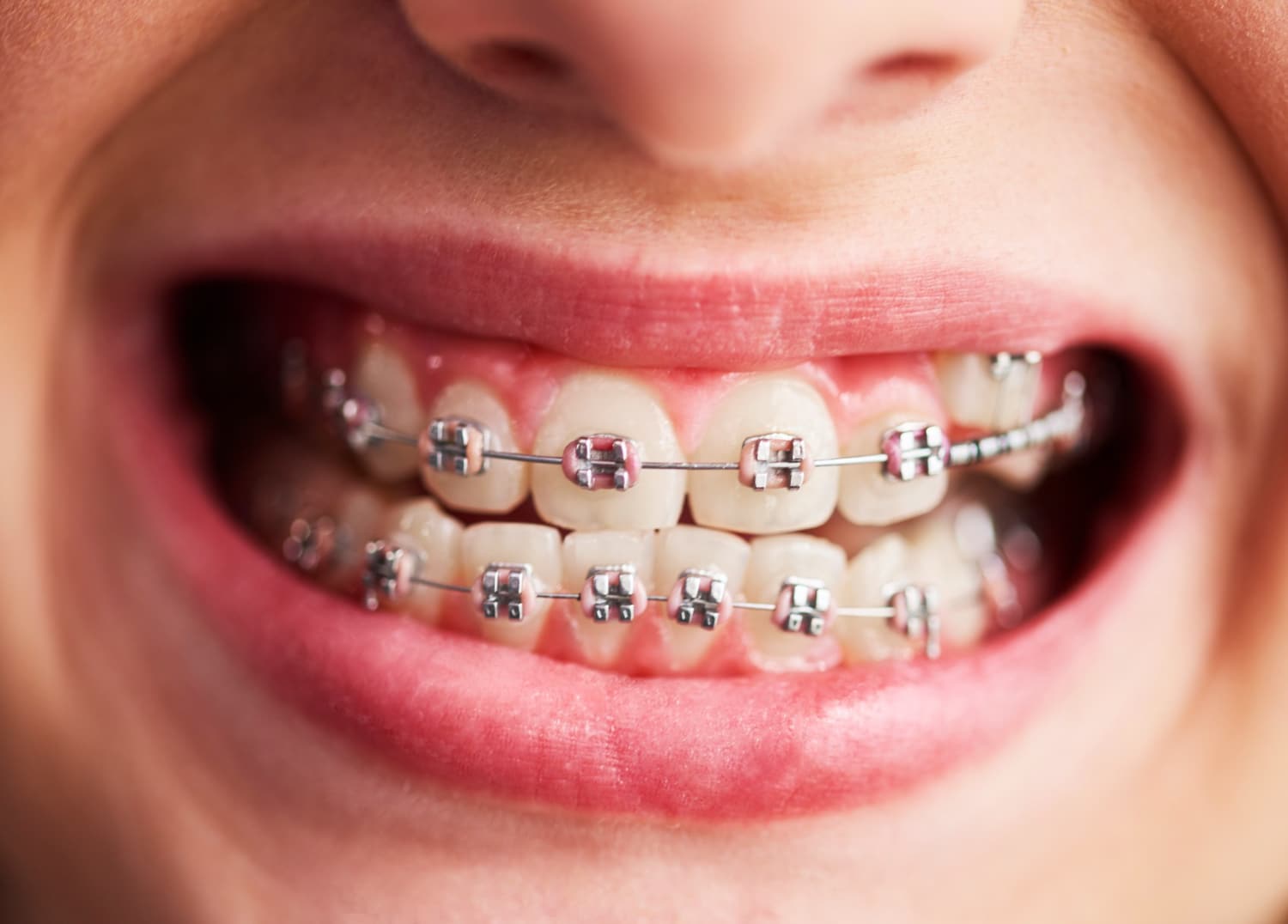 The Truth About Dental Braces: Expert Answers to Top Questions