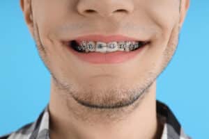 The Truth About Dental Braces: Expert Answers to Top Questions