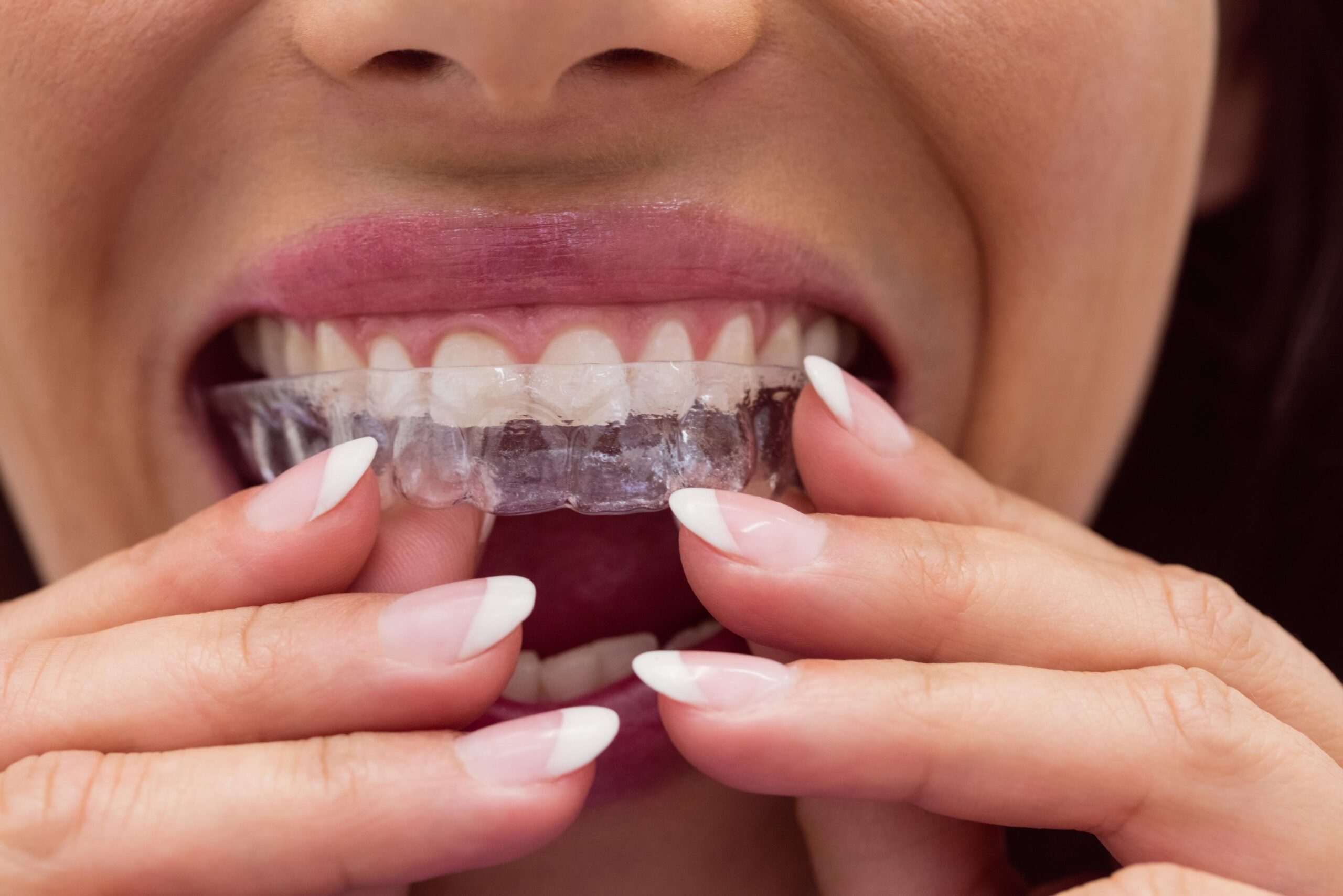 Invisalign AI Technology: Revolutionizing Clear Aligner Treatment